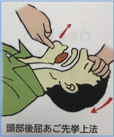 気道確保